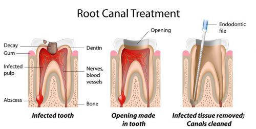 root canal 1 نوشته