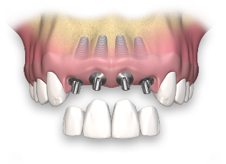 dental implant 2 نوشته