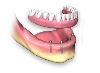 dental implant protes نوشته