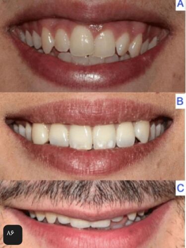 زیباسازی دندان و بهبود طرح لبخند