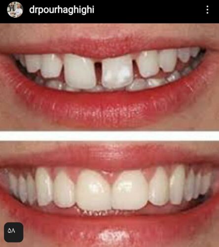 فاصله بین دندان های قدامی