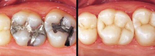 پر کردن دندان با کامپوزیت دندان